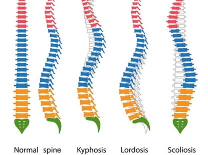 Spinal deformities