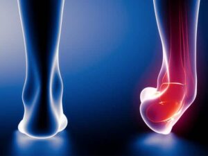 Ankle sprain-symptoms, therapy until healing