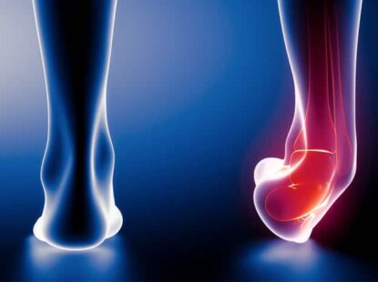 Ankle sprain-symptoms, therapy until healing