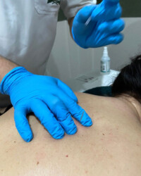 Dry Needling Terapijska tehnika