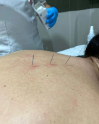 Dry Needling Terapijska tehnika
