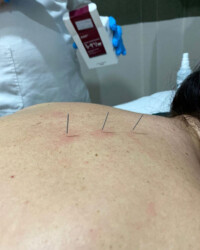 Dry Needling Terapijska tehnika