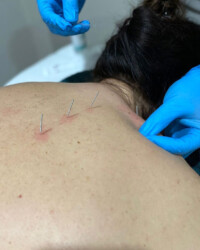 Dry Needling Terapijska tehnika