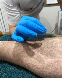 Dry Needling Terapijska tehnika