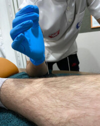 Dry Needling Terapijska tehnika